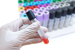 植髮後脫髮：點解會咁？應該點處理？